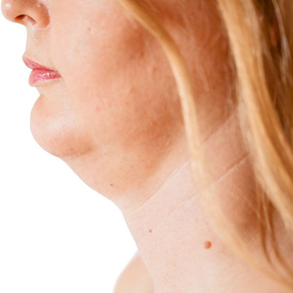 Woman's double chin