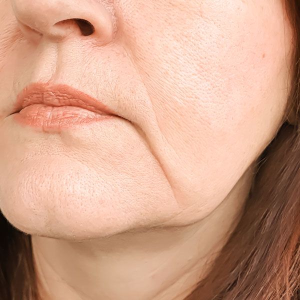 Woman with loose skin under chin