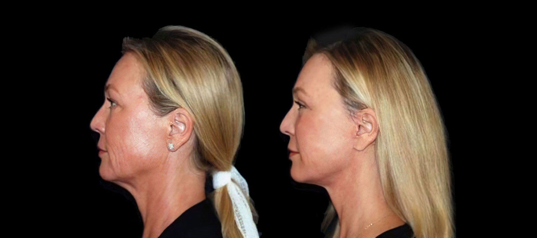 Before and after facelift surgery